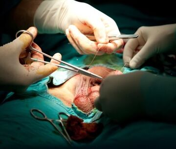 chirurgie d'agrandissement du pénis