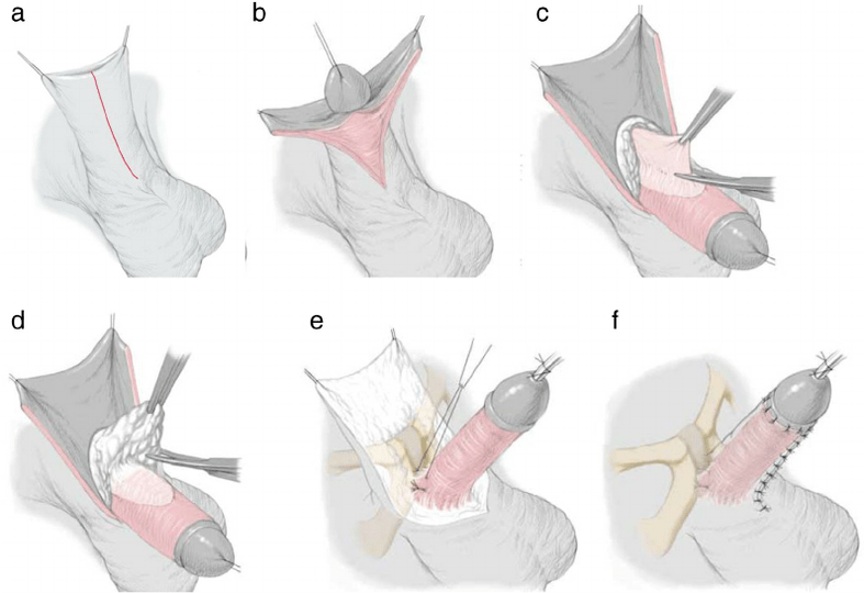 ligamentotomie pour l'agrandissement du pénis
